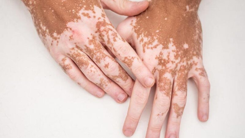 Vitiligo’nun En Hızlı Yayılma Dönemleri ve Önleme Yöntemleri [2026]